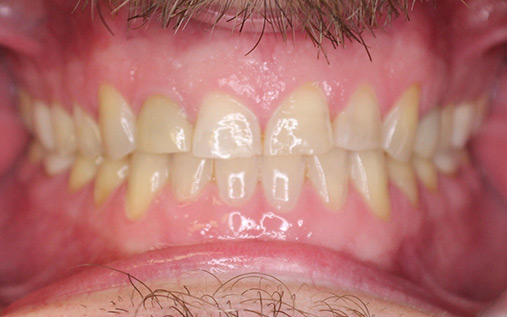 Before Full Mouth Rehabilitation