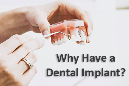 Abilene Family Dentistry explains when dental implants are necessary